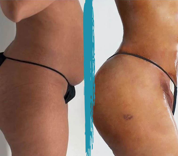 vaser lipo before after gallery patient 18616220 image