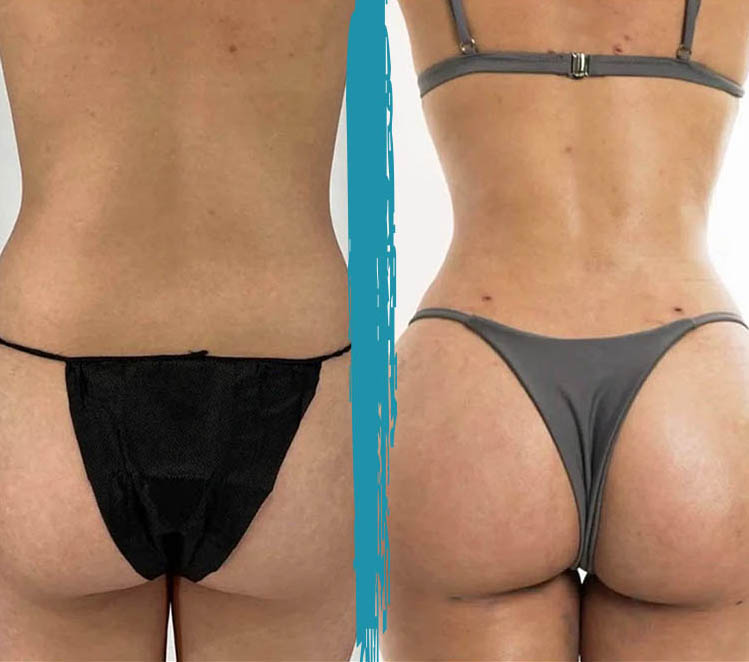 vaser lipo before after gallery patient 18616222 image