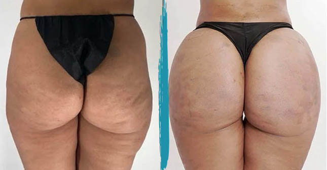 vaser lipo before after gallery patient 18616224 image