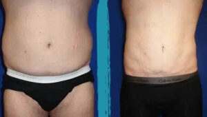 vaser lipo before after gallery patient 18616225 image