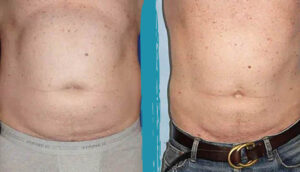 vaser lipo before after gallery patient 18616226 image