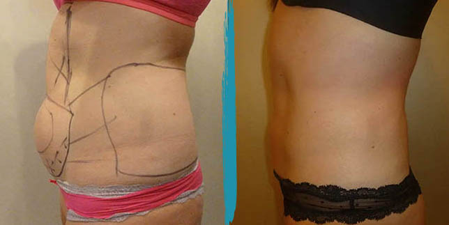 vaser lipo before after gallery patient 18616227 image