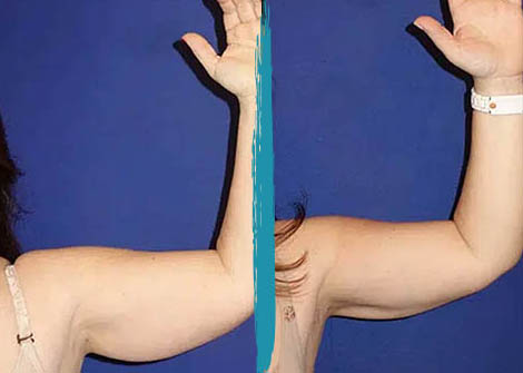 vaser lipo before after gallery patient 18616228 image