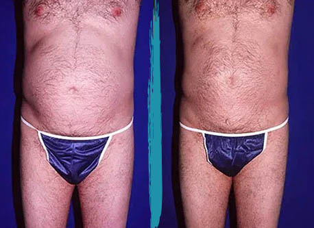 vaser lipo before after gallery patient 18616230 image