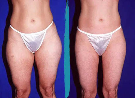 vaser lipo before after gallery patient 18616231 image