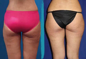 vaser lipo before after gallery patient 18616232 image