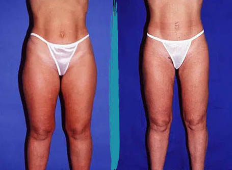 vaser lipo before after gallery patient 18616233 image