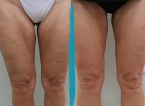 vaser lipo before after gallery patient 18616234 image