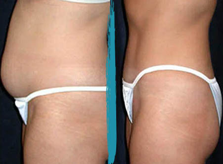 vaser lipo before after gallery patient 18616235 image