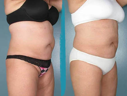 vaser lipo before after gallery patient 18616236 image