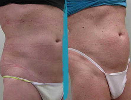 vaser lipo before after gallery patient 18616237 image