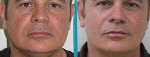 vaser lipo before after gallery patient 18616239 image