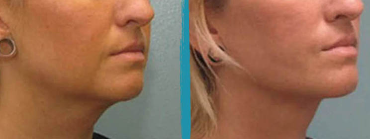 vaser lipo before after gallery patient 18616241 image