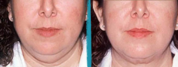 vaser lipo before after gallery patient 18616242 image