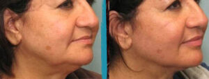 vaser lipo before after gallery patient 18616243 image