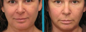 vaser lipo before after gallery patient 18616244 image