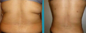 vaser lipo before after gallery patient 18616246 image