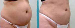 vaser lipo before after gallery patient 18616247 image