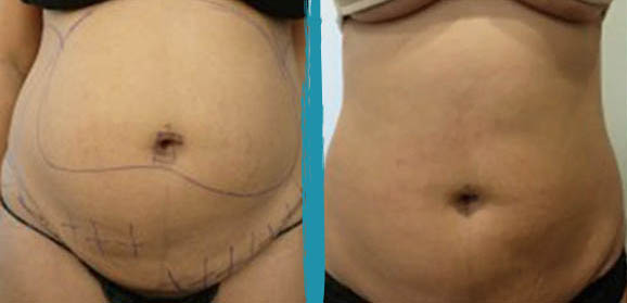 vaser lipo before after gallery patient 18616248 image