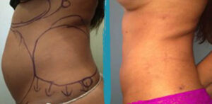 vaser lipo before after gallery patient 18616249 image