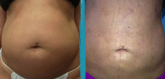 vaser lipo before after gallery patient 18616250 image