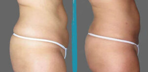 vaser lipo before after gallery patient 18616251 image