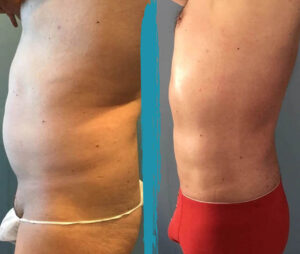 vaser lipo before after gallery patient 18616253 image