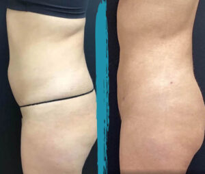 vaser lipo before after gallery patient 18616256 image