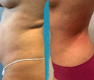 vaser lipo before after gallery patient 18616257 image