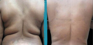 vaser lipo before after gallery patient 18616258 image