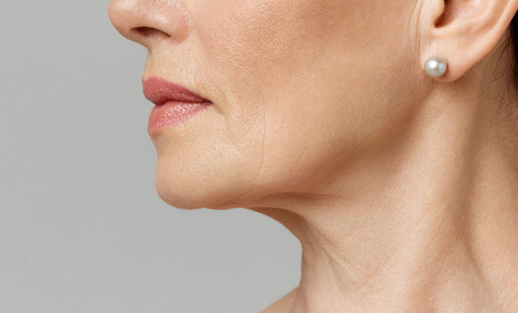 Bellafill dermal filler for jawline