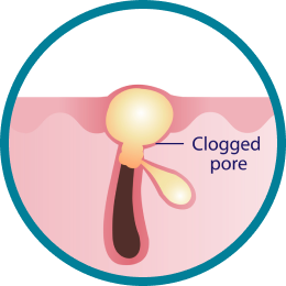 Clogged Pores