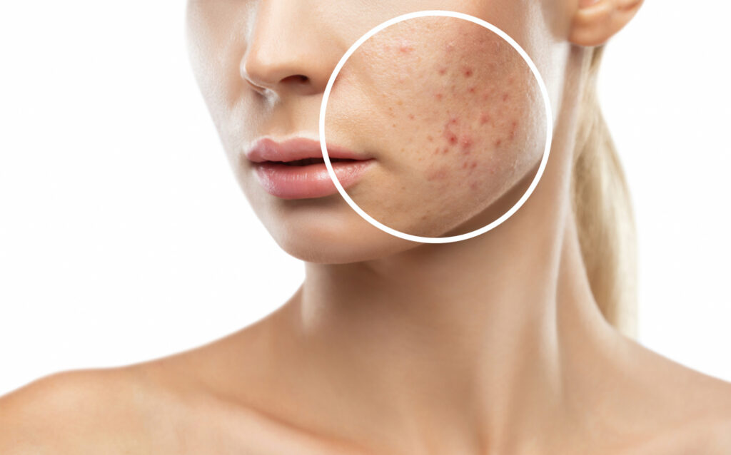 Grade 3 acne scar removal NYC