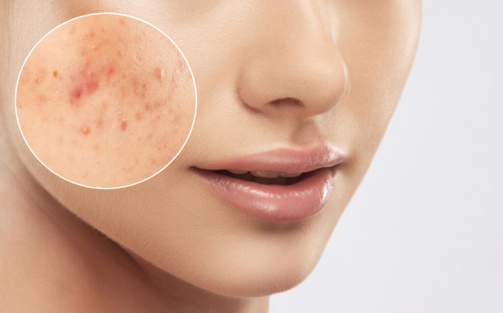 Grade 4 acne scar treatment nyc