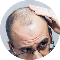 Men and Women with Androgenic Alopecia