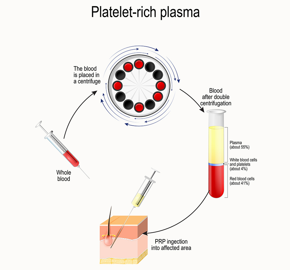 PRP Hair Restoration Process NYC