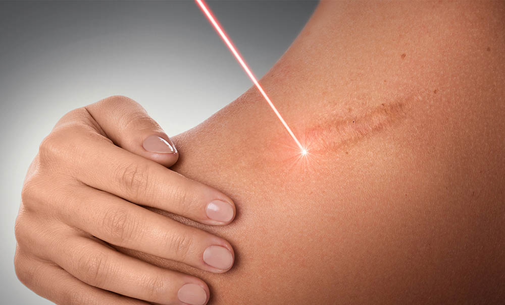 IPL Scar Laser Removal NYC