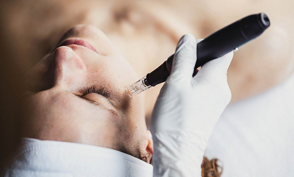 microneedling scar revision treatment