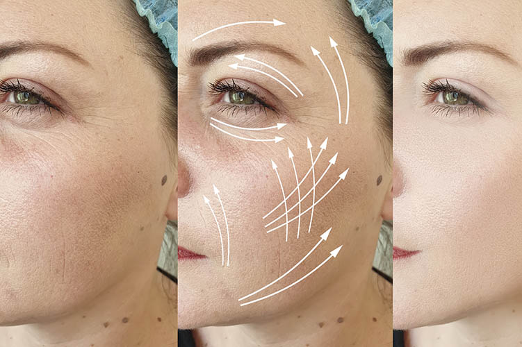 Profound Non-Surgical Skin Tightening